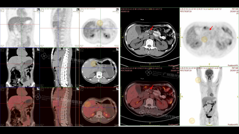 1-034435988.png 【对比】恩迪PET-CT 检查报告_02_副本.png