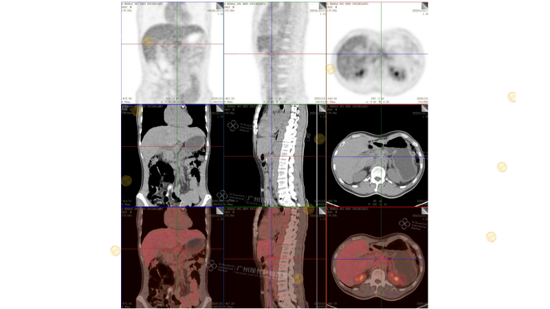 【治疗前】恩迪PET-CT 检查报告_02_副本.png