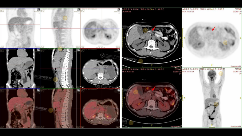 【对比】恩迪PET-CT 检查报告_02_副本.png