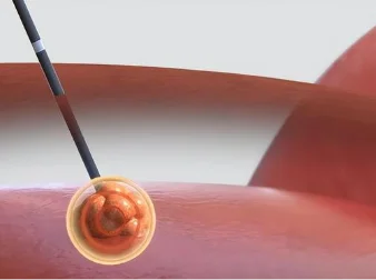 การจี้เย็น / การจี้ด้วยคลื่นไมโครเวฟ (Cryoablation / Microwave ablation)