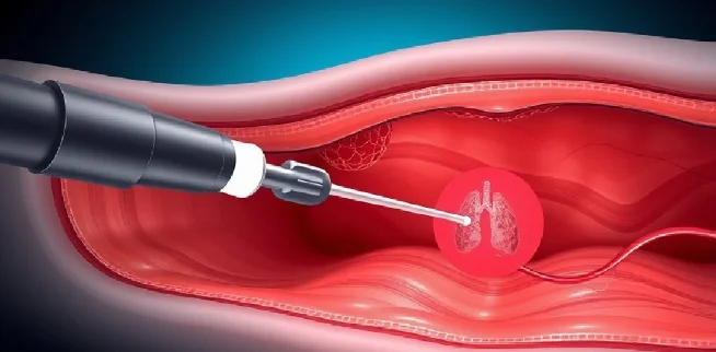 การรักษาคีโมเฉพาะจุดแบบแผลเล็ก