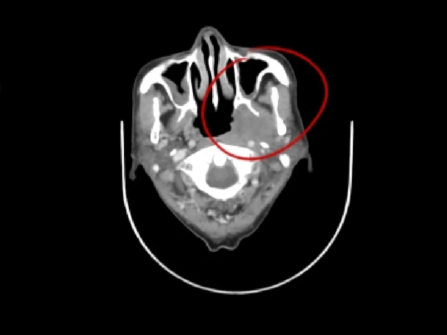 CT image after treatment