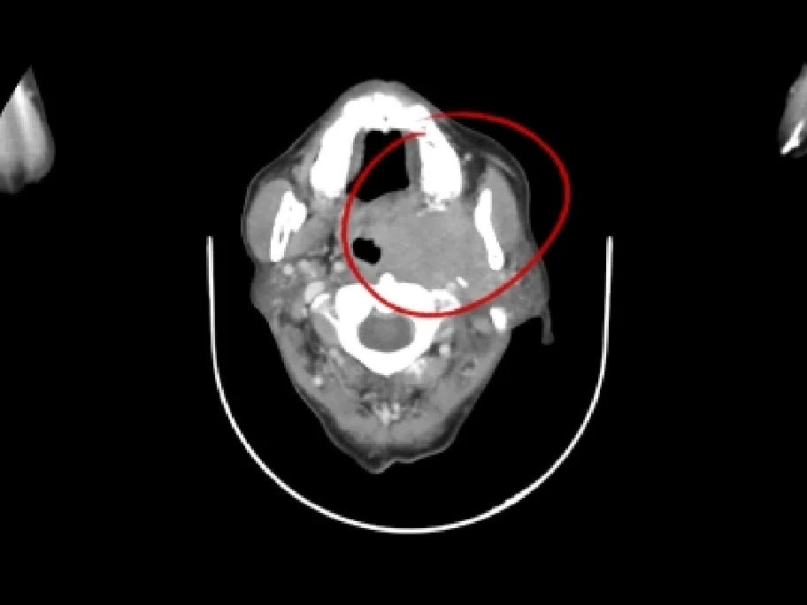 CT image before treatment