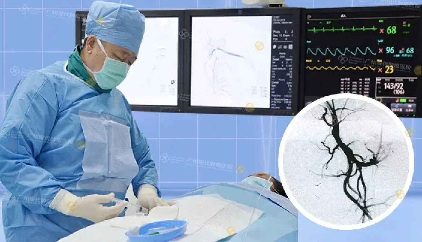 Can thiệp hóa chất cục bộ