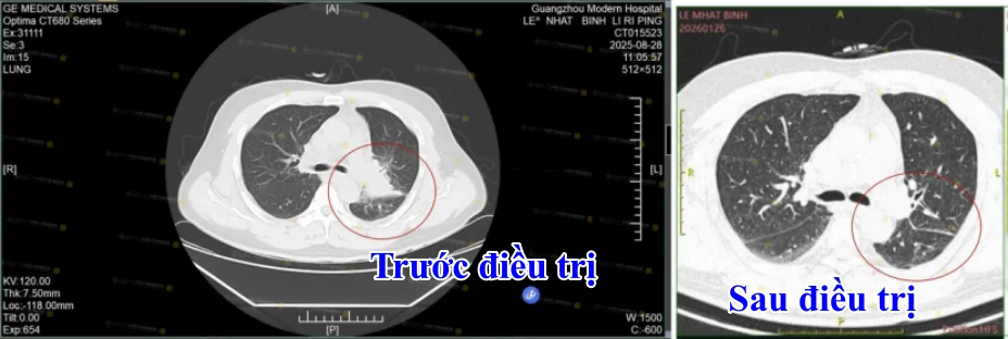 Hình ảnh CT đối chiếu của Lê Nhật Bình