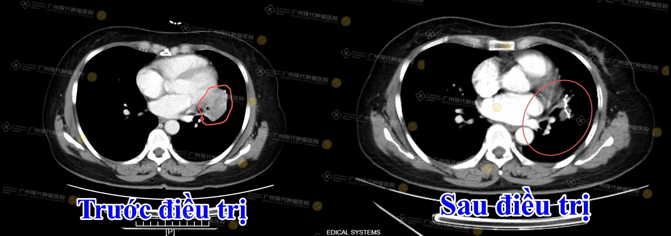 Hình ảnh CT đối chiếu của bà Nguyễn Lan