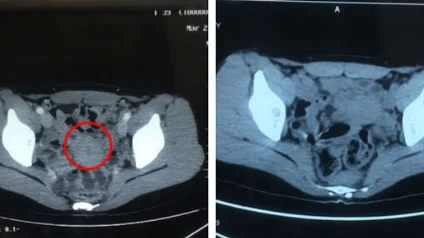 Hình ảnh CT trước và sau điều trị