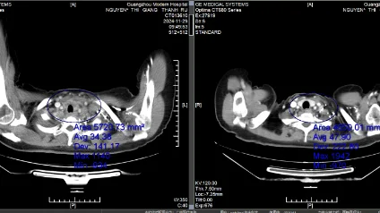 Hình ảnh CT trước và sau điều trị