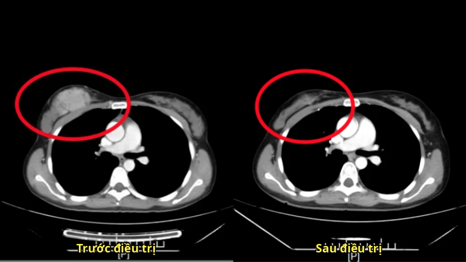 Hình ảnh CT trước và sau điều trị của Nguyễn Thị Giang Thanh