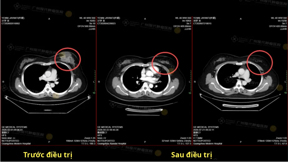 Hình ảnh CT trước và sau điều trị của Yến Nê