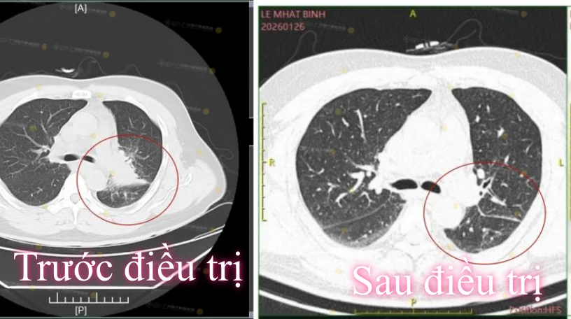 So sánh phim chụp CT cắt lớp vi tính