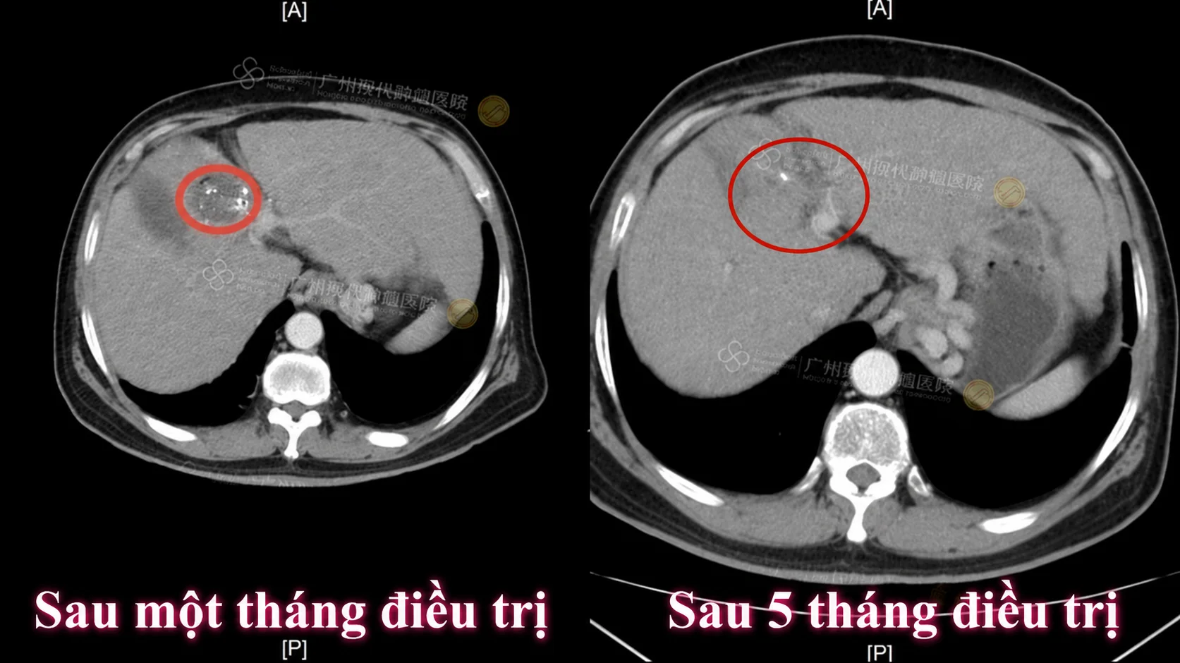 So sánh phim chụp CT cắt lớp vi tính