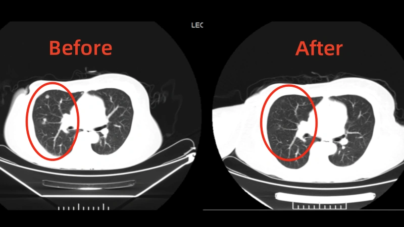 Leonisa – Philippines – Breast cancer stage IV