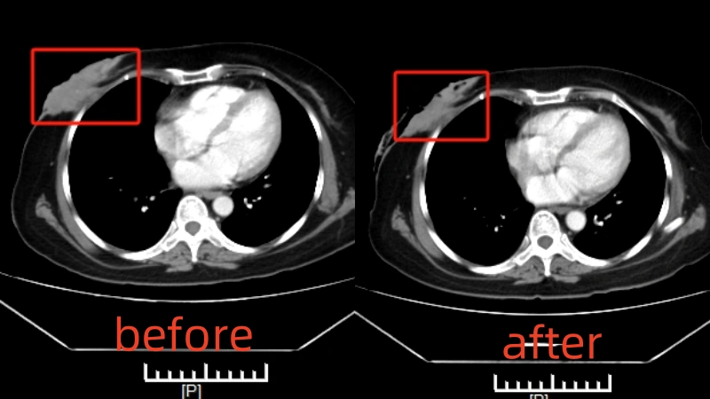 Venus - Philippines - Breast cancer stage IV