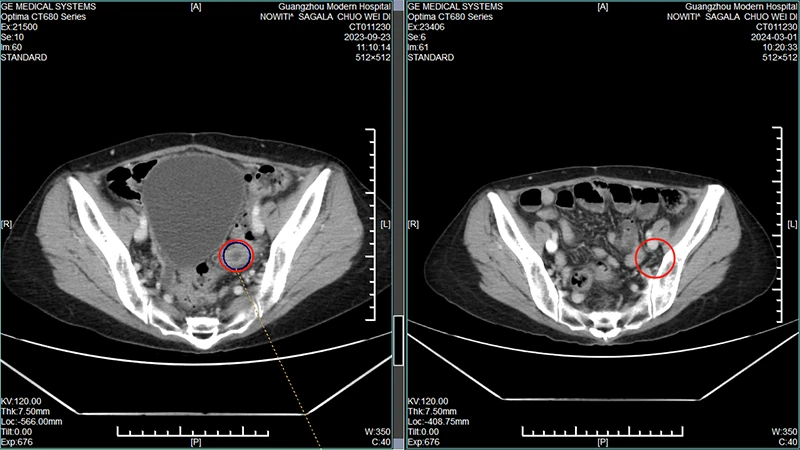 Indonesian Ovarian Cancer Patient: Nowiti