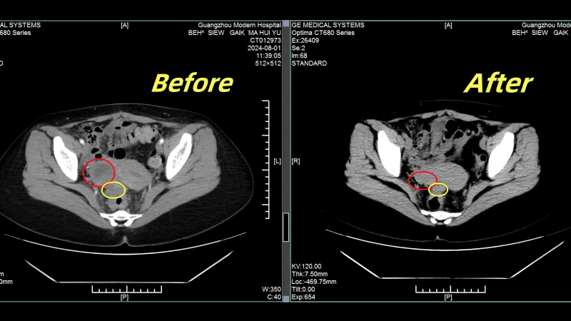 Malaysian Ovarian Cancer Patient: Ms. Beh