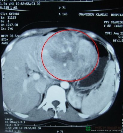 รักษาโรคมะเร็งตับ