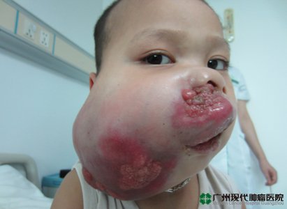 มะเร็งกล้ามเนื้อลายบนใบหน้า 1