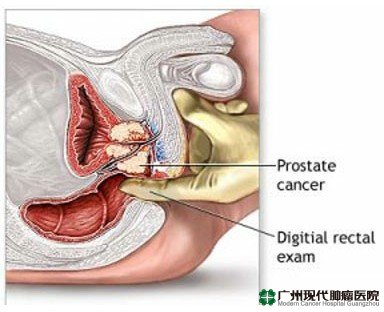 Professional argon-helium knife treatment， let bowel cancer patients once again choose Modern Cancer Hospital Guangzhou