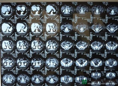 มะเร็งลำไส้ใหญ่