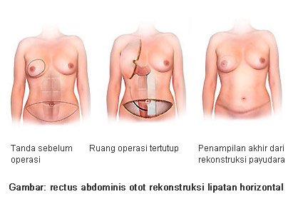 rekonstruksi payudara (Breast Reconstruction), kanker payudara