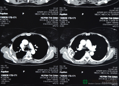 A Vietnamese Patient with Laryngeal Cancer Sharing Her Arduous Anti-cancer Journey