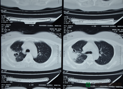 aryngeal cancer, laryngeal cancer treatment