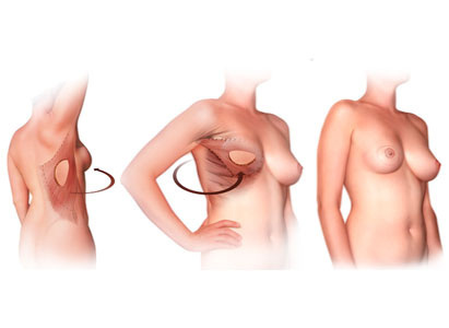 การผ่าตัดเสริมสร้างเต้านม