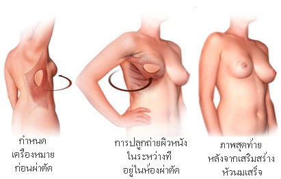 การผ่าตัดเสริมสร้างเต้านม