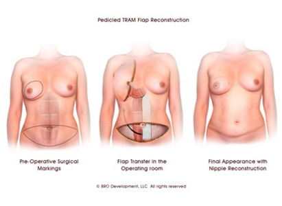 การผ่าตัดเสริมสร้างเต้านม