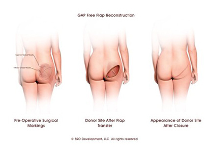 การผ่าตัดเสริมสร้างเต้านม