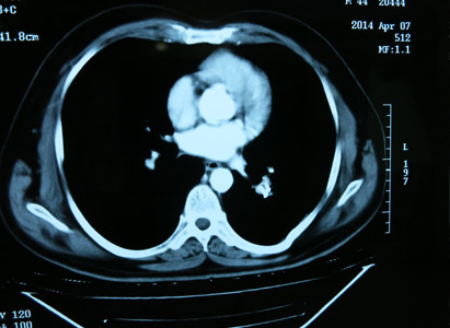 Kanker paru-paru, Intervensi, Penanaman Biji Partikel, Cryosurgery