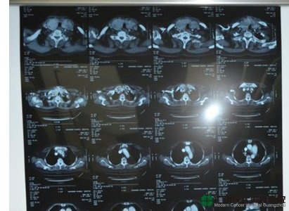 مستشفى قوانغتشو الحديثة السرطان، وسرطان الثدي