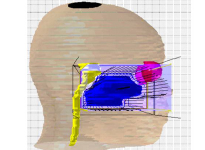 Conformal Radiotherapy Kills Cancer Precisely