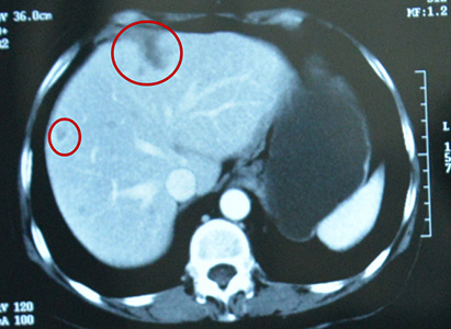 Kanker endometrium, Cryosurgery Ablation, Modern Cancer Hospital Guangzhou