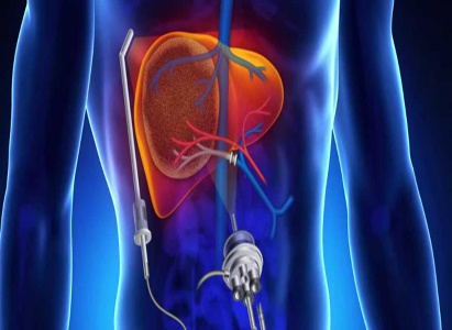 Microwave ablation (MWA), cancer, cancer treatment, Modern Cancer Hospital Guangzhou, minimally invasive treatment, cancer symptoms, cancer diagnosis