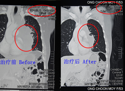 Modern Cancer Hospital Guangzhou, lung cancer, lung cancer treatment, cancer treatment in China, interventional therapy, cryotherapy