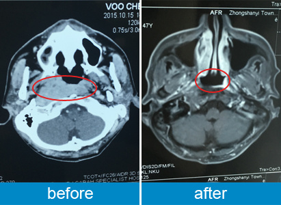 VOO CHEW WAH: Interventional Therapy helps me overcome Stage IV