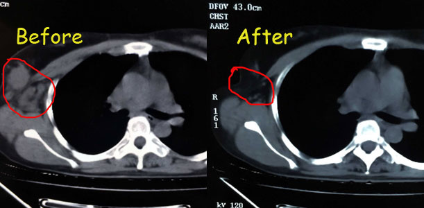 breast cancer, breast cancer treatment, interventional therapy, St. Stamford Modern Cancer Hospital Guangzhou