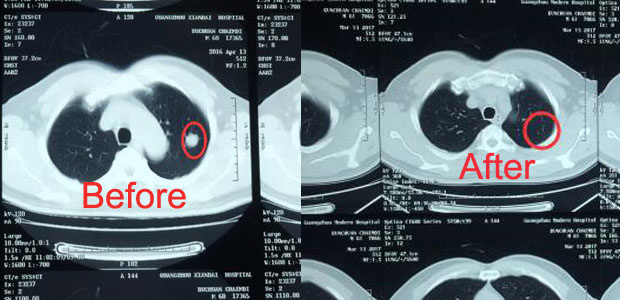 coloretal cancer, coloretal cancer treatment, cancer treatment, minimally invasive therapy, interventional therapy, cryotherapy, invasive targeted therapy and combination of TCM and western medicine