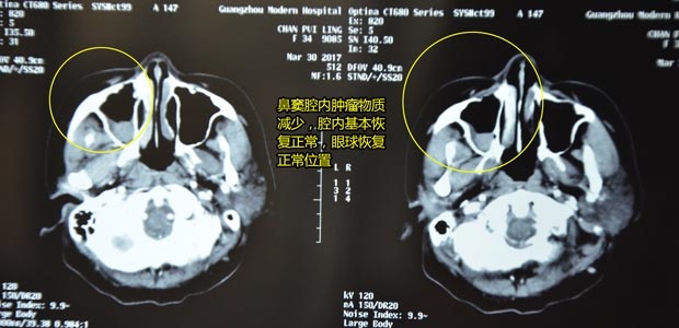 cancer treatment, parotid gland cancer, minimally invasive therapy, interventional therapy, particle implantation, natural therapy, St. Stamford Modern Cancer Hospital Guangzhou