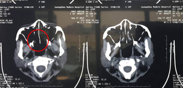 nasopharyngeal cancer, symptoms of nasopharyngeal cancer, treatment for nasopharyngeal, minimally invasive treatment, St.Stamford Modern Cancer Hospital Guangzhou.