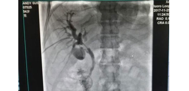 linear 125 I seeds implantation combined with biliary or portal vein stent insertion,bile duct cancer,St. Stamford Modern Cancer Hospital Guangzhou, cancer, cancer treatment