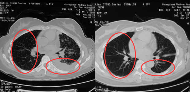 St.Stamford Modern Cancer Hospital Guangzhou, lung cancer, lung cancer treatment, minimally invasive therapy, interventional therapy, chemotherapy