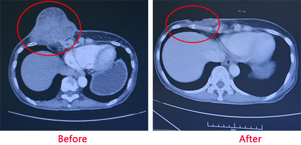 Breast cancer, breast cancer treatment, minimally invasive therapy, interventional therapy, cryotherapy, St. Stamford Modern Cancer Hospital Guangzhou.