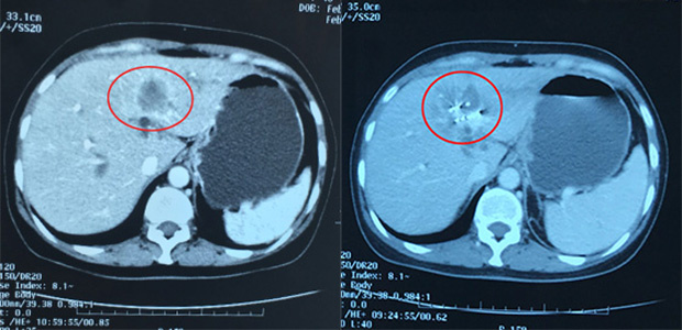 Bile duct cancer, minimally invasive therapy, interventional therapy, cryotherapy, particle implantation, St. Stamford Modern Cancer Hospital Guangzhou.