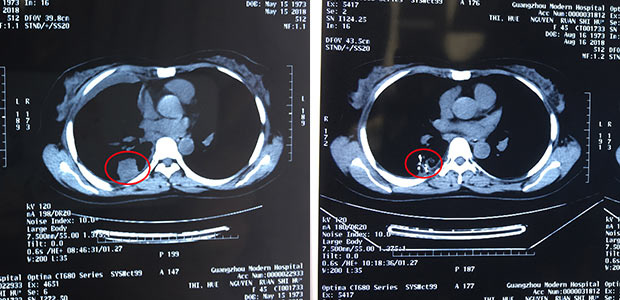 lung cancer, minimally invasive therapy, particle implantation, interventional therapy, St. Stamford Modern Cancer Hospital Guangzhou