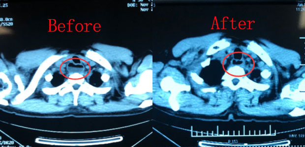 esophageal cancer, St. Stamford Modern Cancer Hospital Guangzhou, interventional therapy, photodynamic therapy