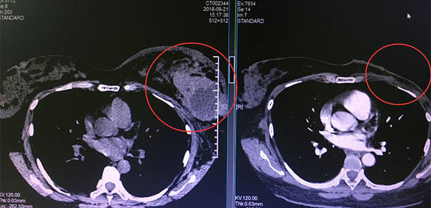 breast cancer, interventional therapy, cryotherapy, St. Stamford Modern Cancer Hospital Guangzhou.