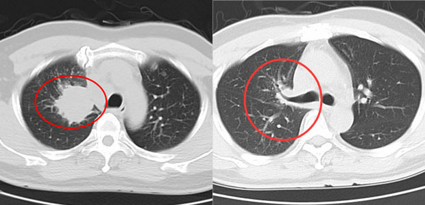  lung cancer, lung cancer treatment, minimally invasive therapy, interventional therapy, particle implantation, microwave ablation, St. Stamford Modern Cancer Hospital Guangzhou.